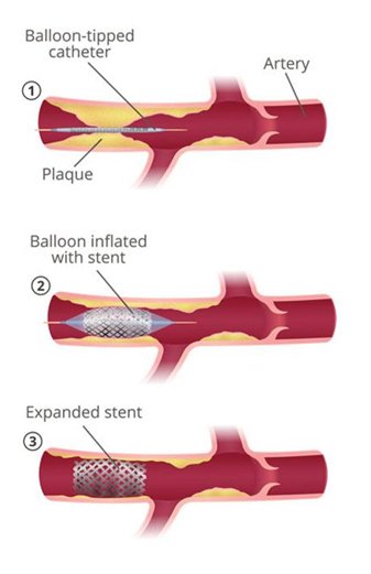 ptca-balloon-hm1